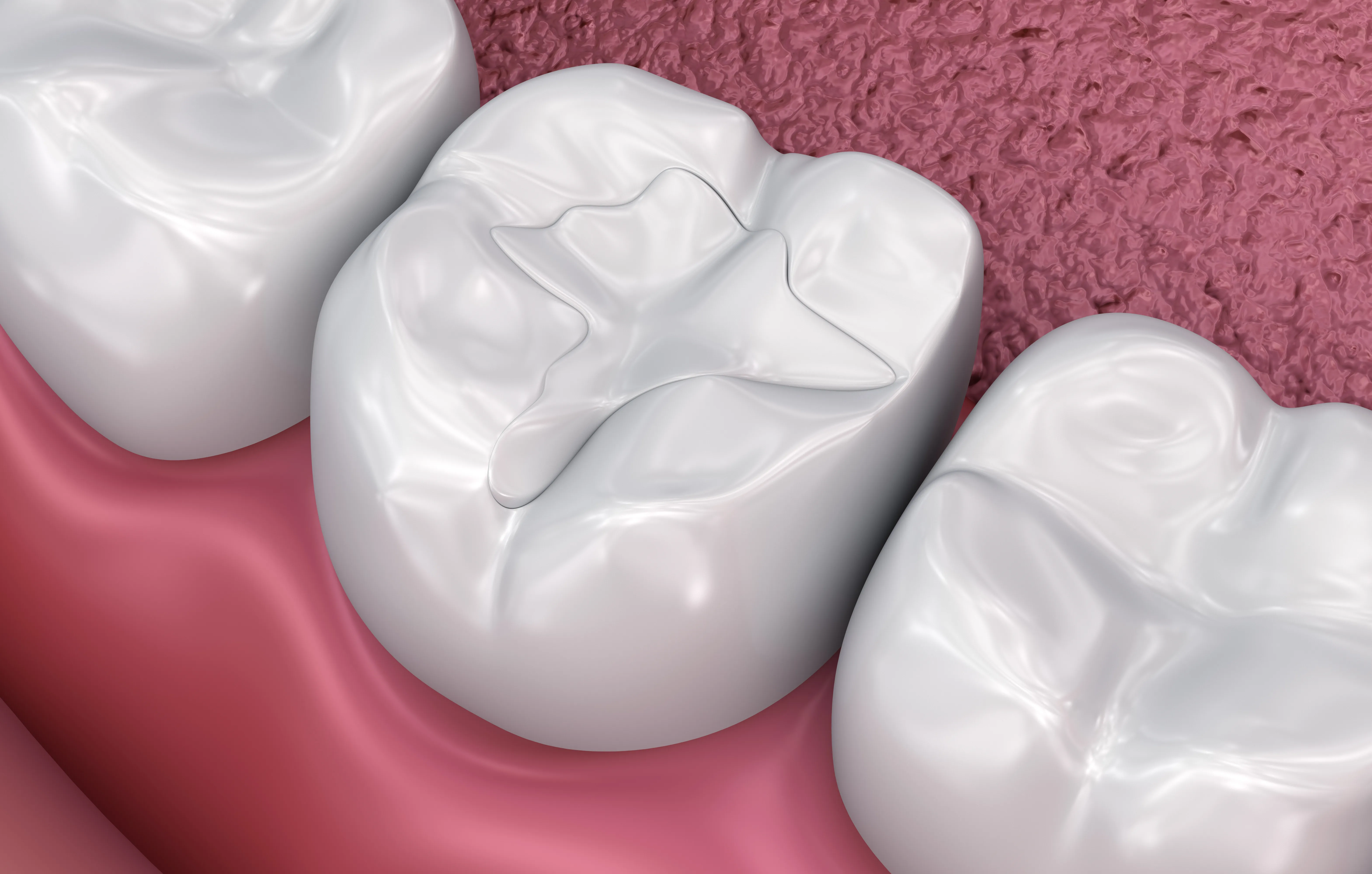 Composite Dental Fillings