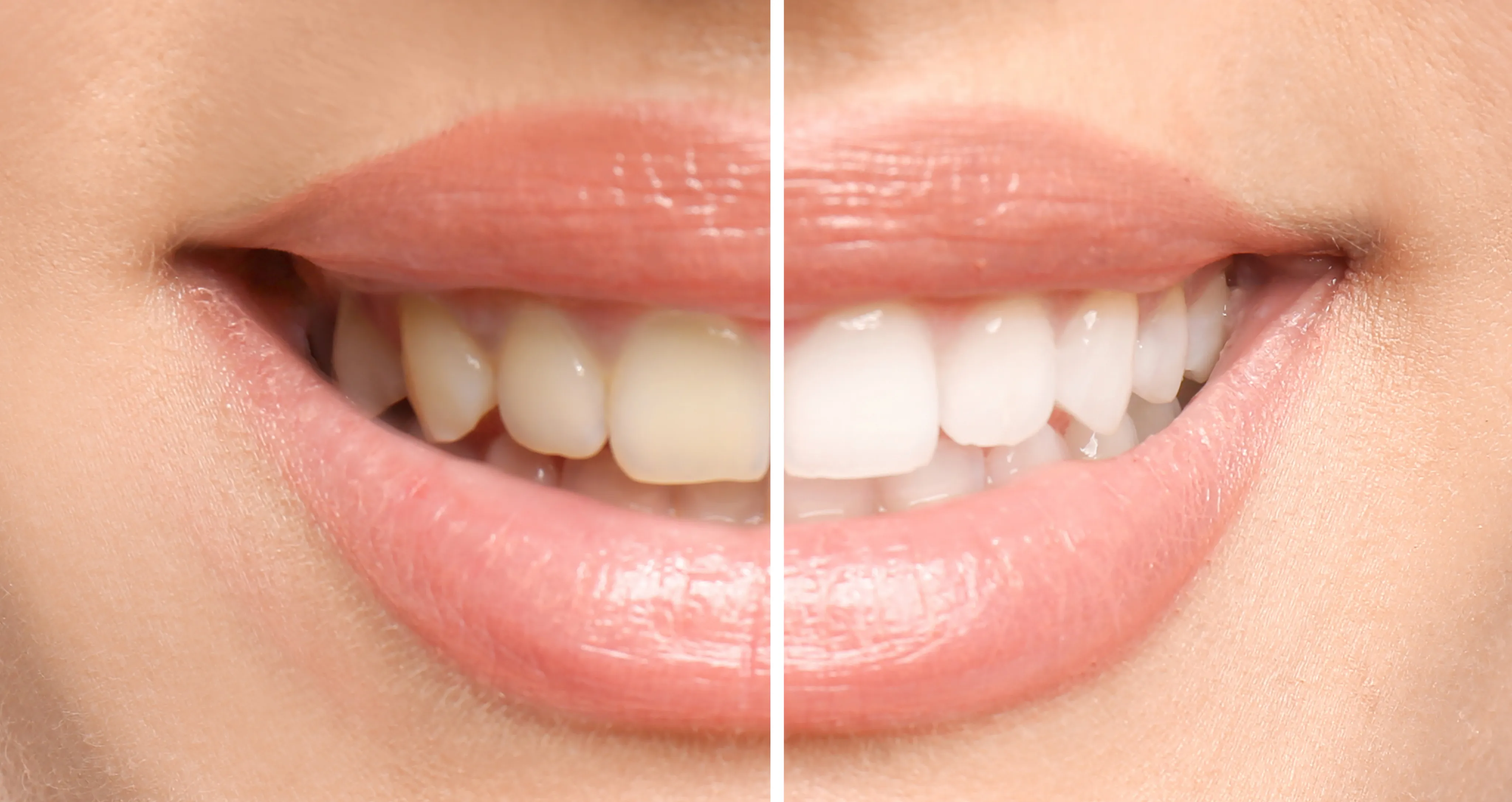 Ready for a Brighter Smile?
